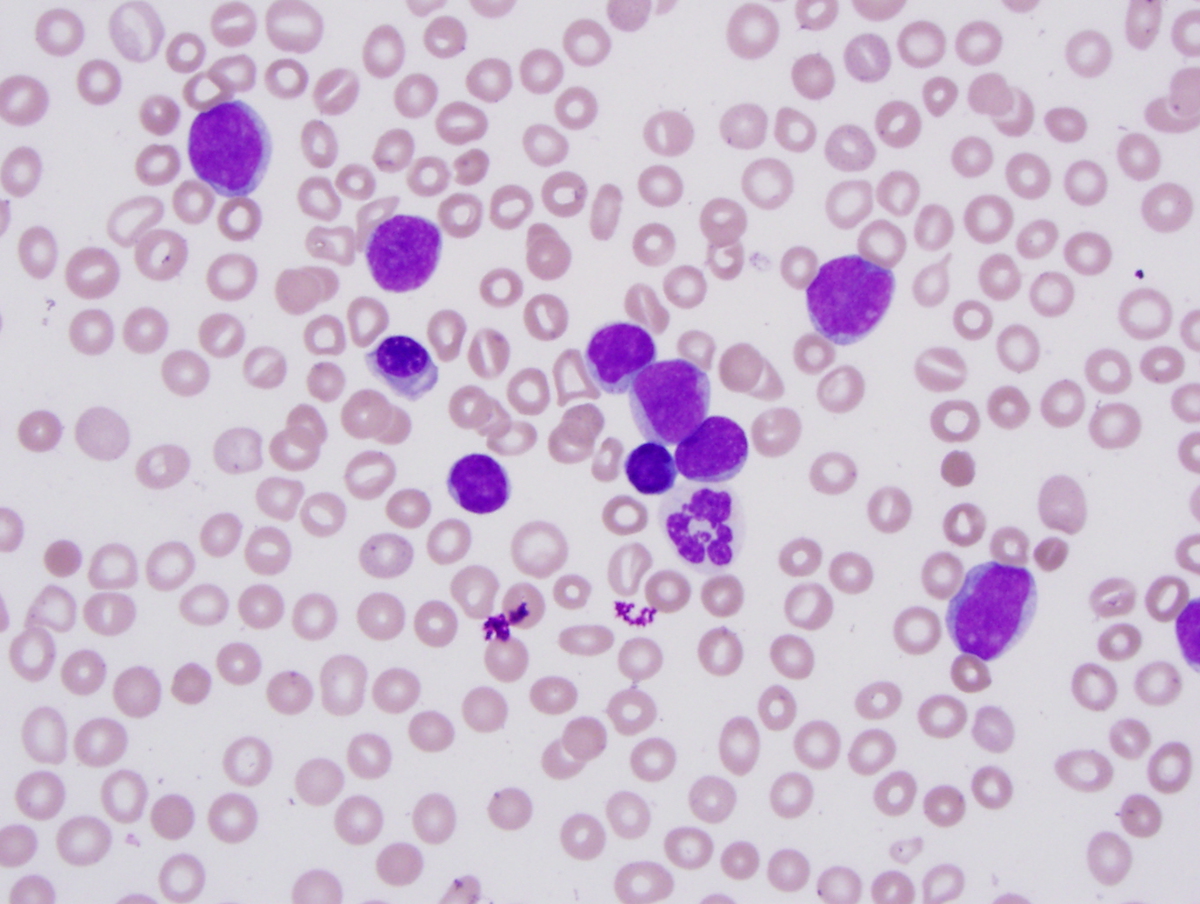 Peripheral blood smear with blasts and a hypogranular neutrophil